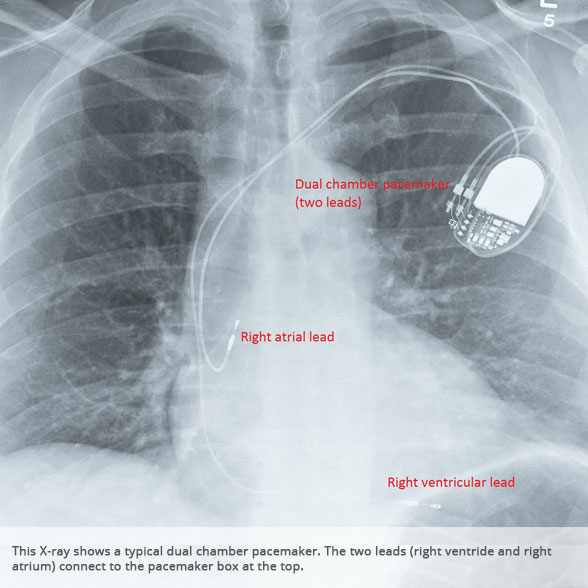 Dual chamber pacemaker